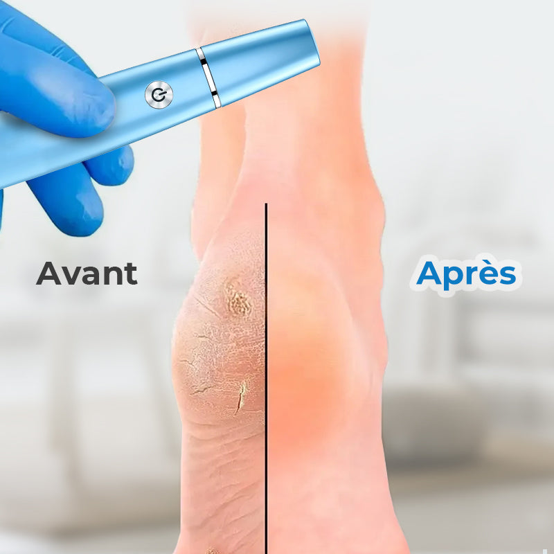 🌸Fête des mères vente chaude 50% RÉDUCTION 🌸Extracteur de callosités électrique pour les pieds