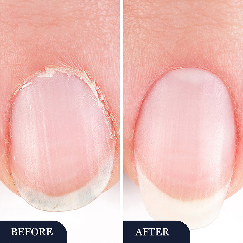 ✨Nouveautés🔥Stylo de traitement contre les champignons des ongles des pieds pour les ongles endommagés